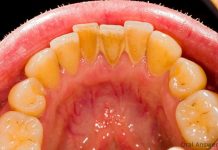 Evo kako sami da skinete kamenac sa zuba. Ove jeftine sastojke već imate kod kuće! (FOTO)